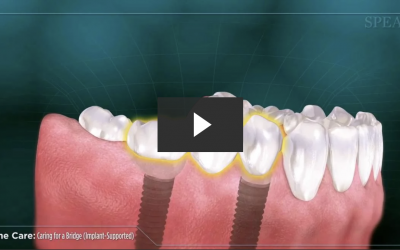 Caring for an Implant-Supported Bridge