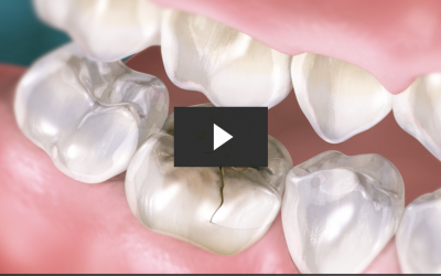Cracked Tooth Repair with Crown (CAD/CAM)