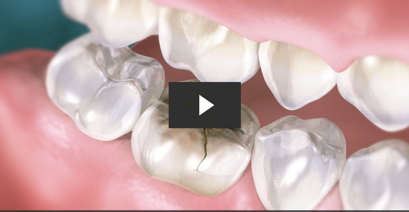 How to Repair A Cracked Tooth With A Crown (CAD/CAM)