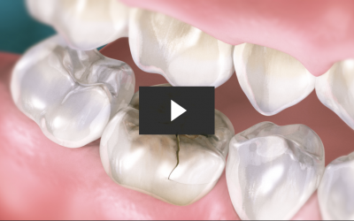 Repairing A Cracked Tooth With A Crown