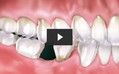 Missing Tooth Replacement with Bridge (Impression)