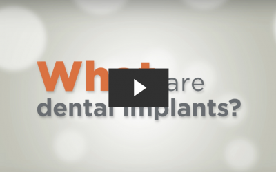 Dental Implants