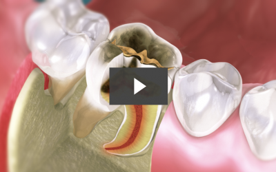 Filling Material Options for Tooth Decay Repair