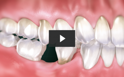 Missing Posterior Tooth Replacement With Implant