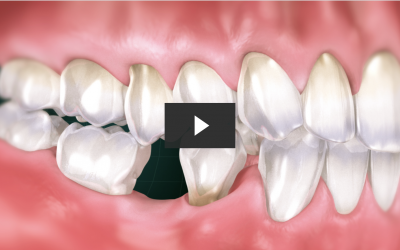Missing Tooth Replacement Bridge (CAD/CAM)