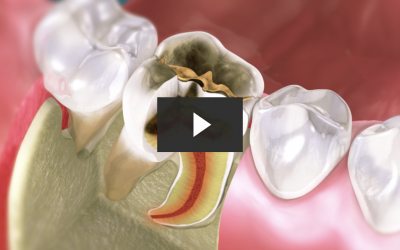 Repairing Posterior Tooth Decay with a Crown (CAD/CAM)