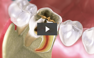 Repairing Posterior Tooth Decay with a Crown (Impression)