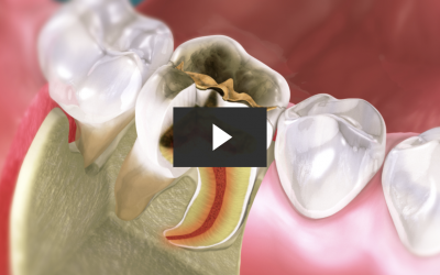 Repairing Tooth Decay with Root Canal and Crown