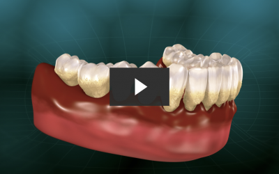 Treating Periodontitis with Gingival Graft