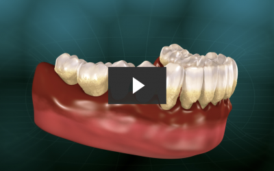 Treating Periodontitis with Connective Tissue Graft