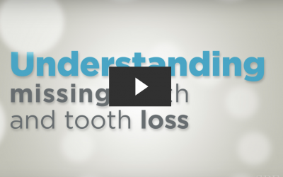 Understanding Missing Teeth & Tooth Loss