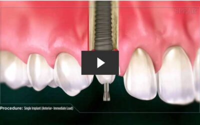 Missing Anterior Tooth Replacement & Implant